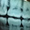 What is a Cavity and How Do You Prevent Getting One?