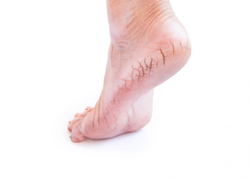 Cracked Heels – How to Take Care of Them